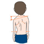 ヨガ・ピラティスを続けた側弯症の変化